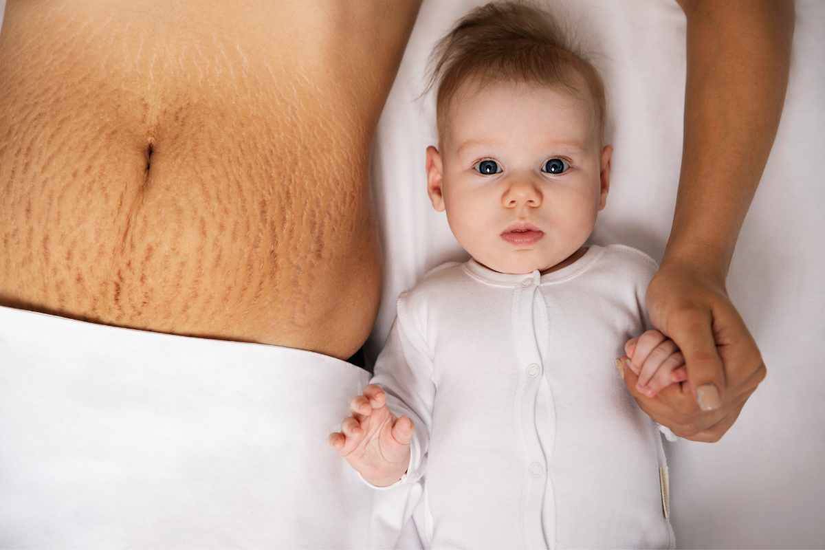 Smagliature in gravidanza e nel post parto: come prendersi cura della pelle